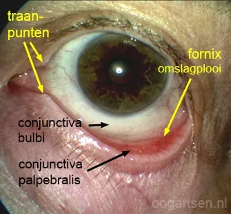 Sterke roodheid van de palpebrale conjunctiva; keer altijd het bovenooglid om bij rood oog z.o.o. Bron: oogartsen.nl
