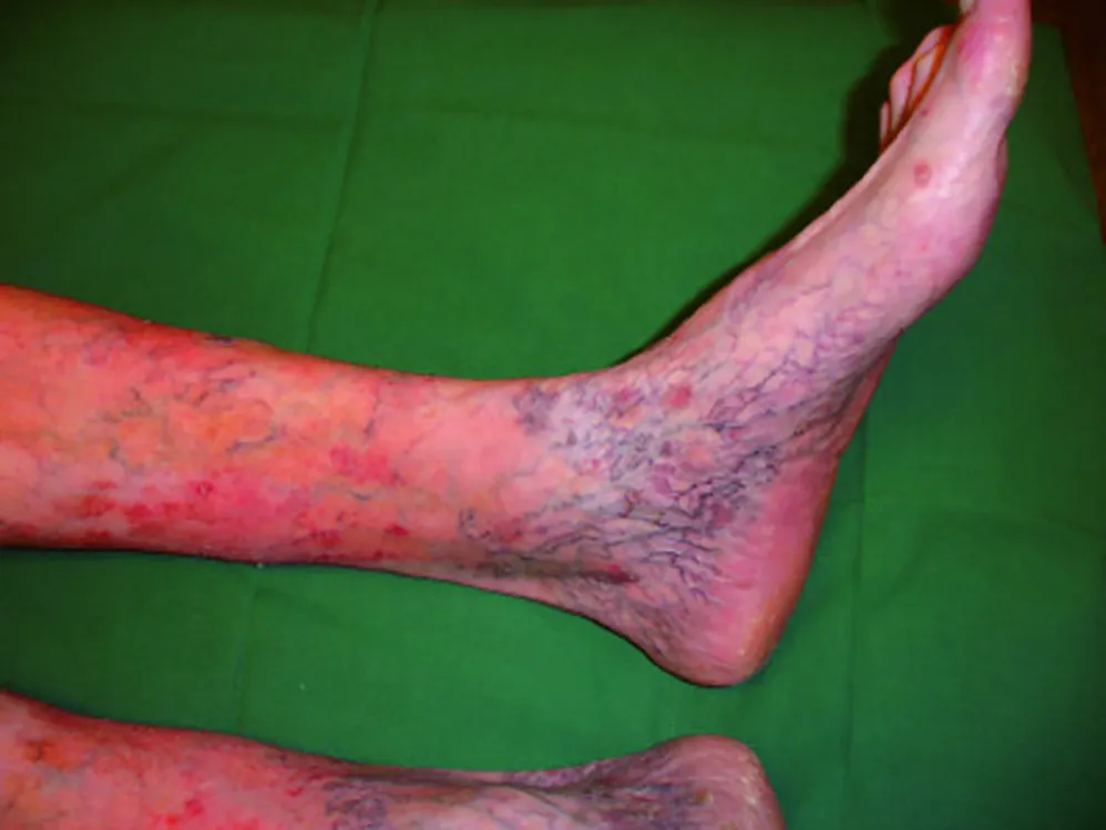 Ankle flare: uitgezette kleine venen mediaal en lateraal aan de enkel